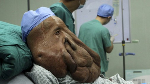 VIDEO – Ārsti Ķīnā veikuši unikālu operāciju cilvēkam ar audzēju uz sejas! (China’s “Elephant Man” looks forward to normal life after tumour removal)