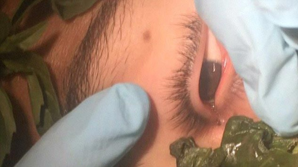 VIDEO: Šausmīgi! Zēnam no acs izvelk… tārpu! (Gruesome Moment Doctors Pull WORM Out of Boy’s Eye)