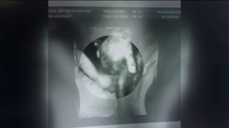VIDEO: Aizkustinoša ultrasonogrāfijas bilde! Mirstošs dvīnis mierinājumu meklē, ieķerdamies māsas rokā..
