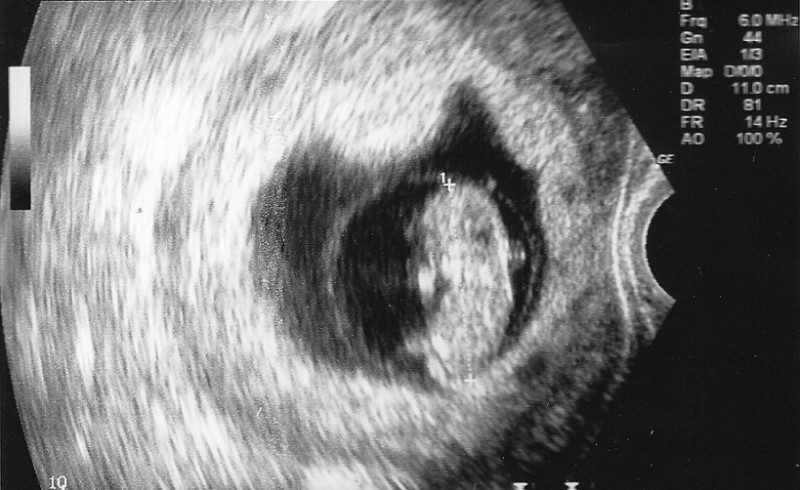 Redzot ultrasonogrāfijas rezultātus, ārsti vecākiem ieteica veikt abortu. Viņi atteicās.. un labi, ka tā..