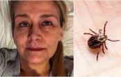 Ērces kodiens atstāj sievieti “piesietu” pie gultas, bez spējām paēst un staigāt Ērces kodiens atstāj sievieti “piesietu” pie gultas, bez spējām paēst un staigāt