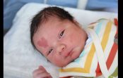 Kā tagad izskatās zēns, kurš piedzima ar sirds formas dzimumzīmi uz pieres Kā tagad izskatās zēns, kurš piedzima ar sirds formas dzimumzīmi uz pieres